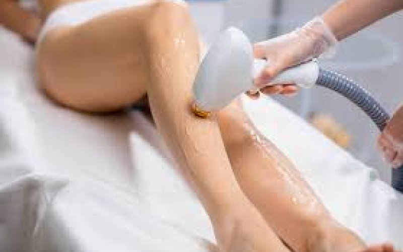 Sakarya Lazer Epilasyon Nedir, Nasıl Yapılır? | Kalıcı ve Etkili Çözümler